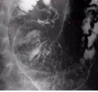 十二指肠球部溃疡解剖位置,十二指肠球部溃疡x线表现