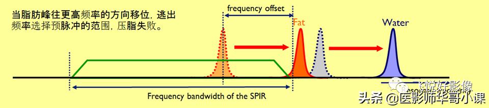 飞利浦磁共振独有技术,飞利浦磁共振减影技术
