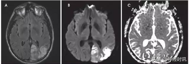 脑卒中的快速识别ppt,脑卒中神经影像学实例解析