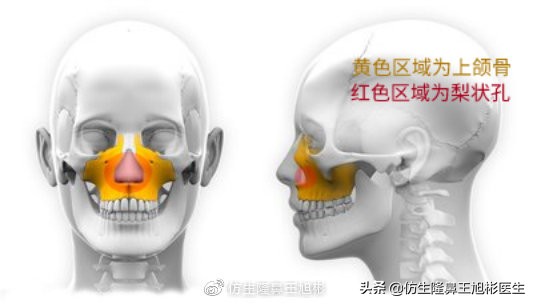 隆鼻手术立体效果,隆鼻后多久可以看出立体感