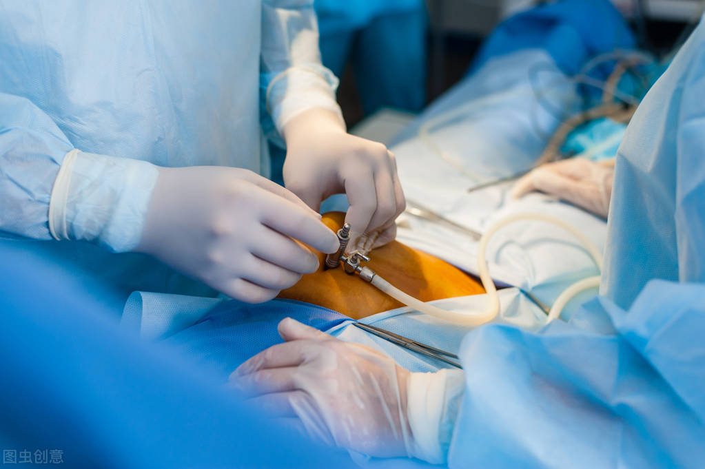 内膜异位巧克力囊肿能用消融术吗,巧克力囊肿是子宫内膜异位症吗