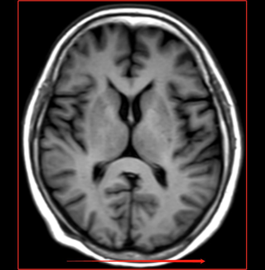 脊柱mr扫描规范,MR扫描各序列特点