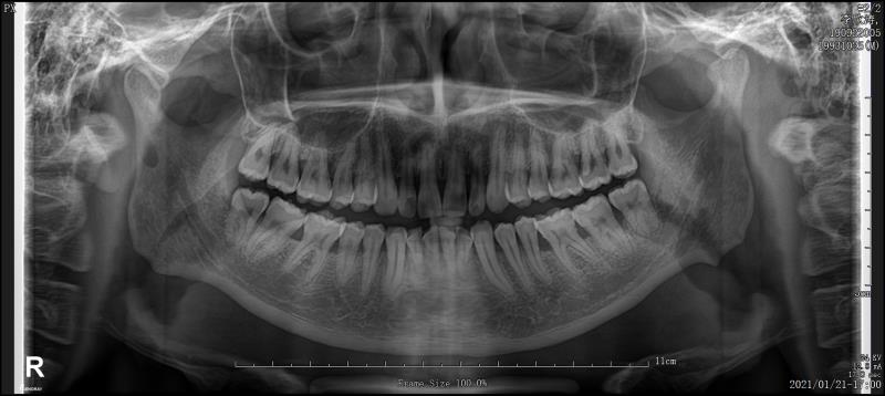 看牙矫正一般去哪里看,矫正牙齿的全套流程