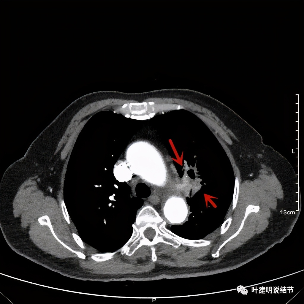 卡瑞利珠单抗治疗肺鳞癌有用吗,特瑞普利单抗对鳞癌治疗有效吗