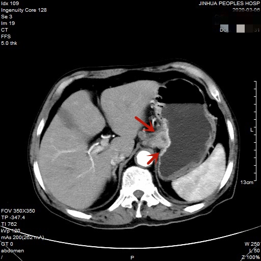 贲门癌80岁手术好还是保守治疗好,医生建议80岁老人做贲门癌手术
