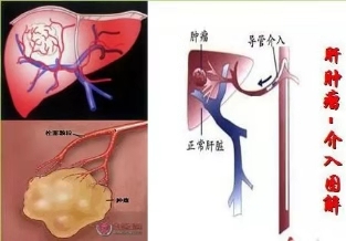 肝血管瘤做微创好还是手术好,巨大肝血管瘤介入手术缺点
