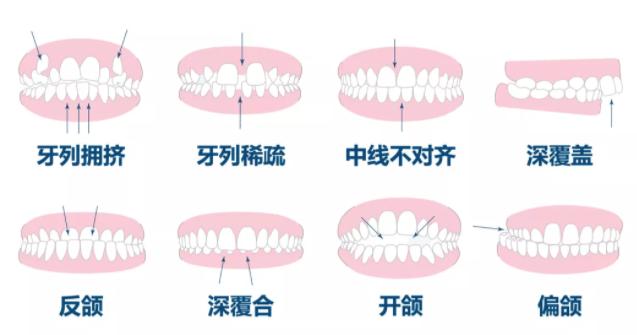 戴牙套脸变丑了怎么办,戴牙套为什么脸变丑了