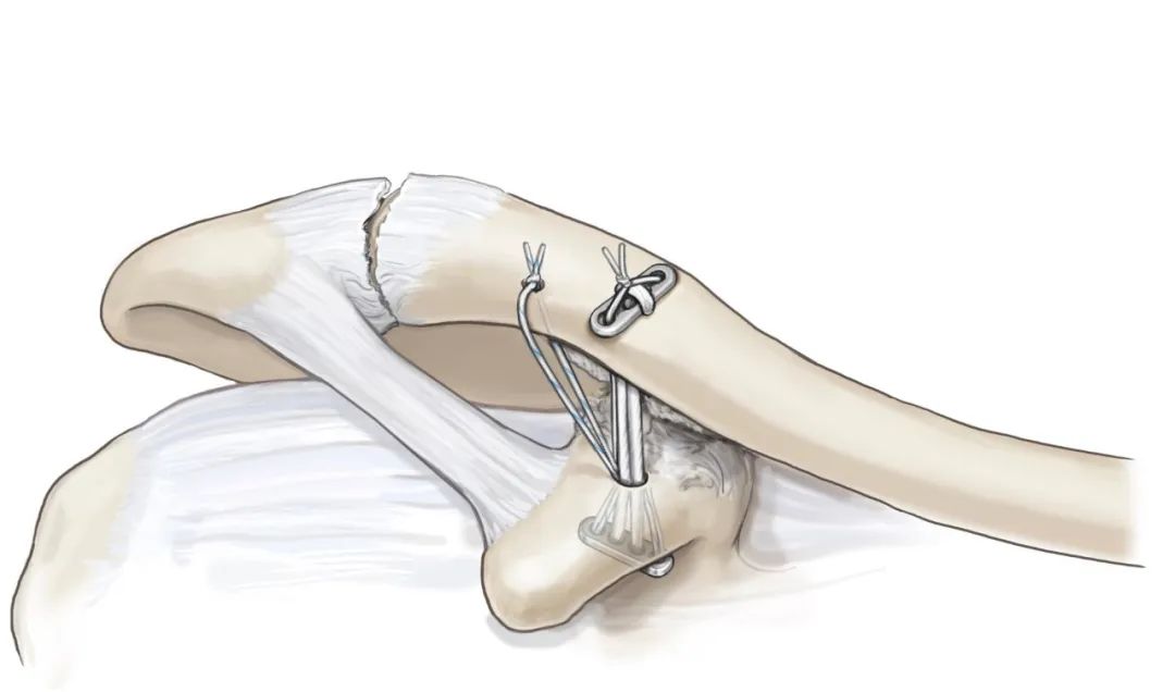 肩锁关节脱位等级及图片,解剖学肩关节