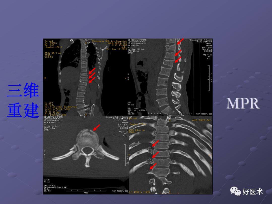 脊柱mri有哪些特点,乳腺疾病的mri诊断及鉴别