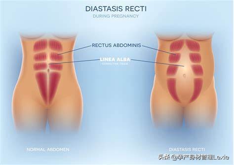 产后怎么站有利于腹直肌修复,产后腹直肌分离恢复的最快方法
