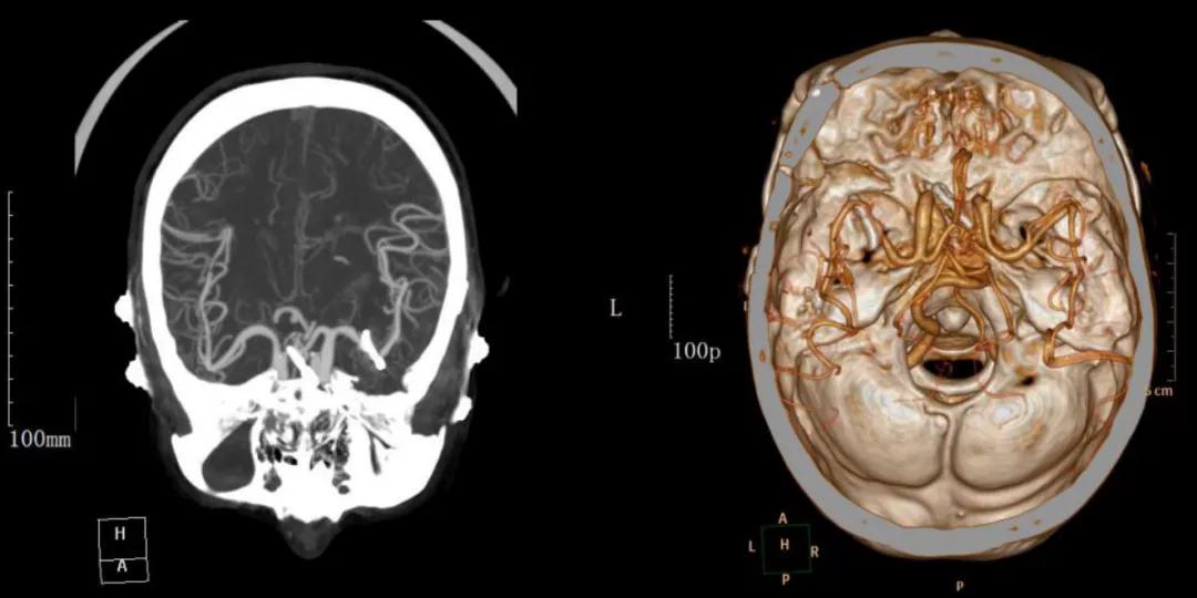突然头疼要炸了怎么回事,睡觉突然头疼剧烈要炸了