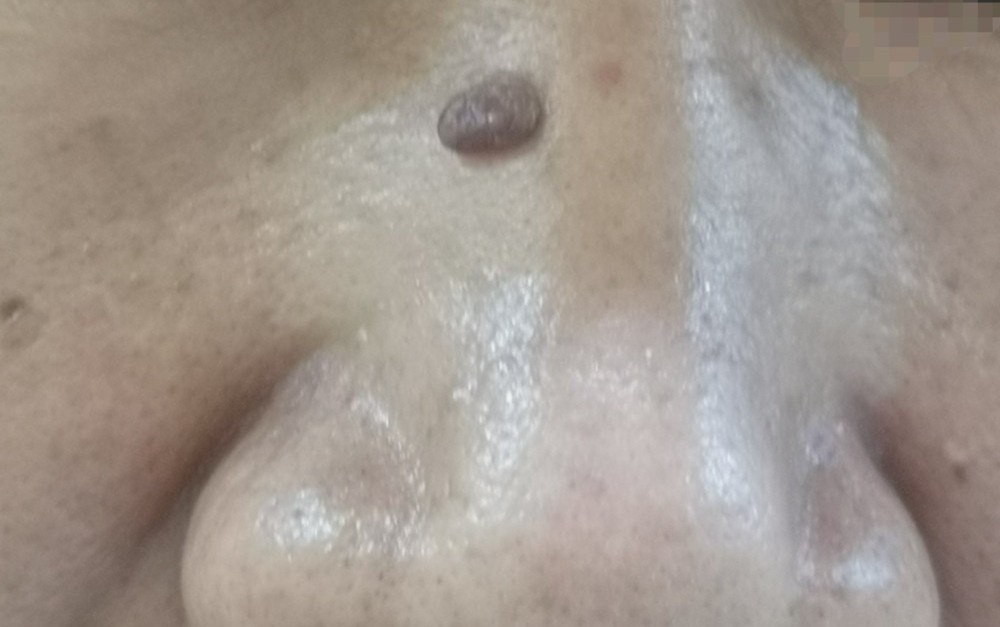 鼻梁上长了一个硬疙瘩是怎么回事,鼻梁上长了个黑色肉粒怎么回事