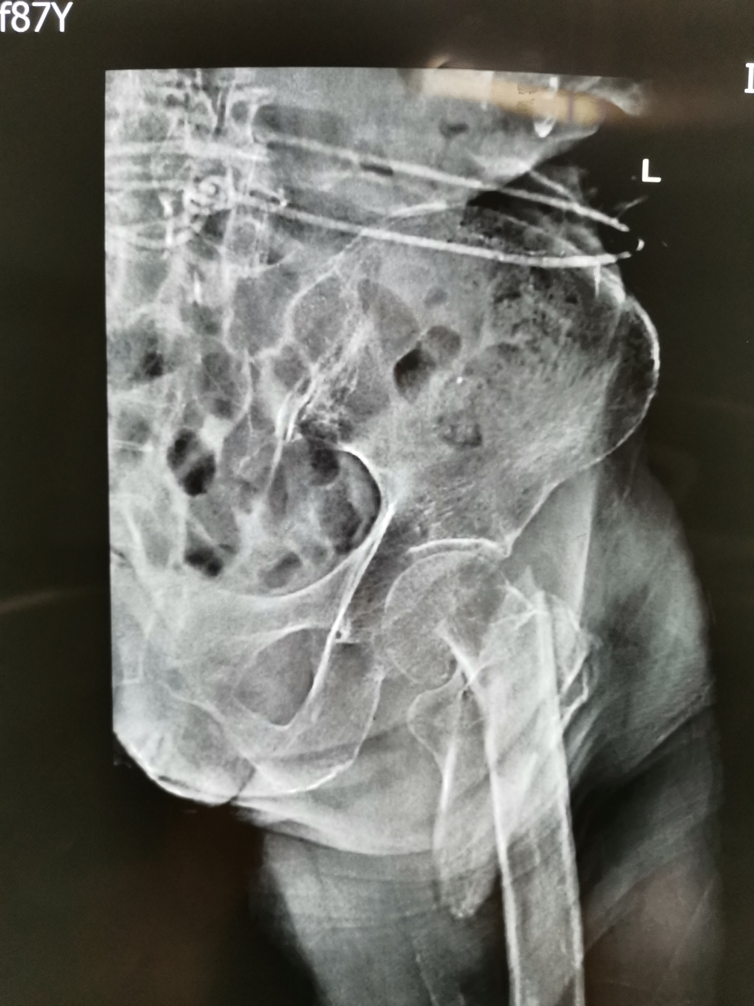 老人摔一跤屁股骨折,老人一屁股坐在地上大腿骨折