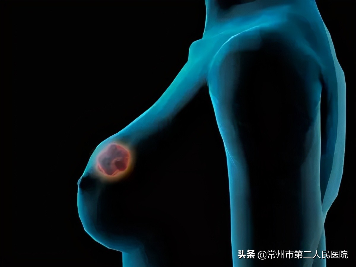 55岁女人胸部长肿瘤,52岁女士胸部长个小瘤子越来越大