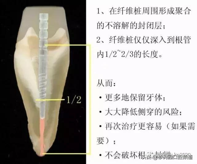 纤维桩的优点和缺点,看完这篇文章就明白了