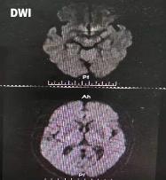 哪些药物会导致震颤,震颤病怎么回事