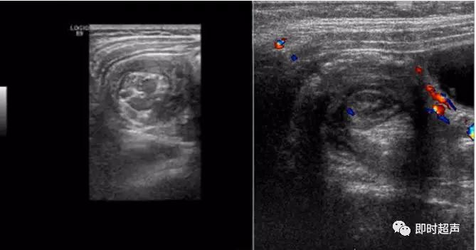 小儿消化道急症超声