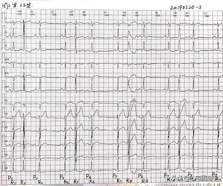 房性早搏有时伴心室内差异性传导,室性早搏伴差异性传导心电图