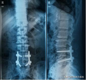 腰间盘突出脚麻腰疼怎么解决,腰间盘突出腰疼的不能动怎么办