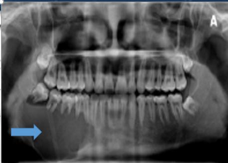 颌骨空洞是肿瘤吗,牙根部发现有个黑洞