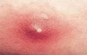 挤完的痘痘,挤痘痘后的正确方式