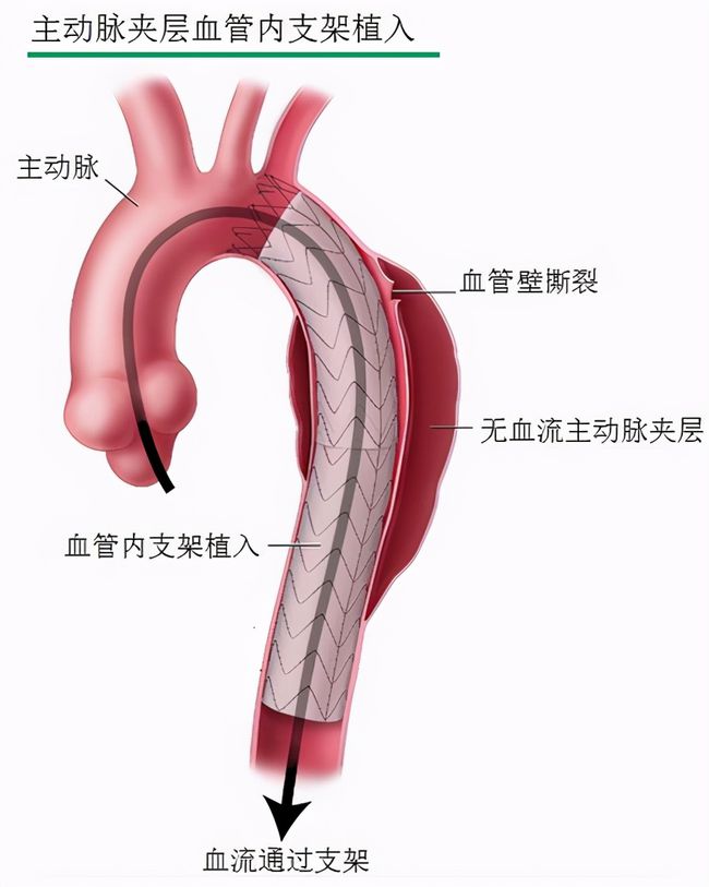 主动脉夹层常见死因,主动脉夹层的分型及危害
