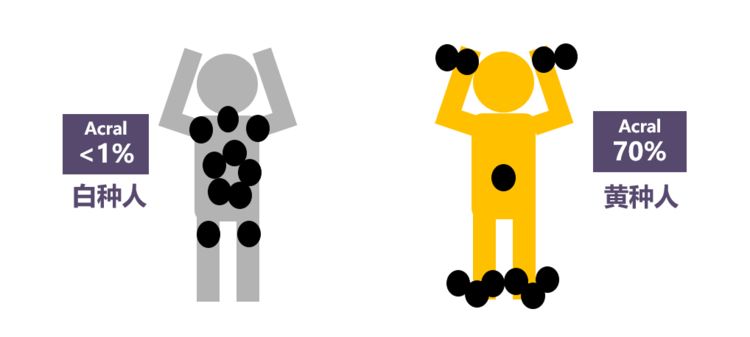 黑色素痣癌变的前兆切除能治愈吗,激光点黑色素痣能诱发恶变吗