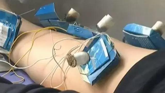 吓skr人！“火烤活人”可以治病？这种火疗很危险，小心玩火*焚自**！