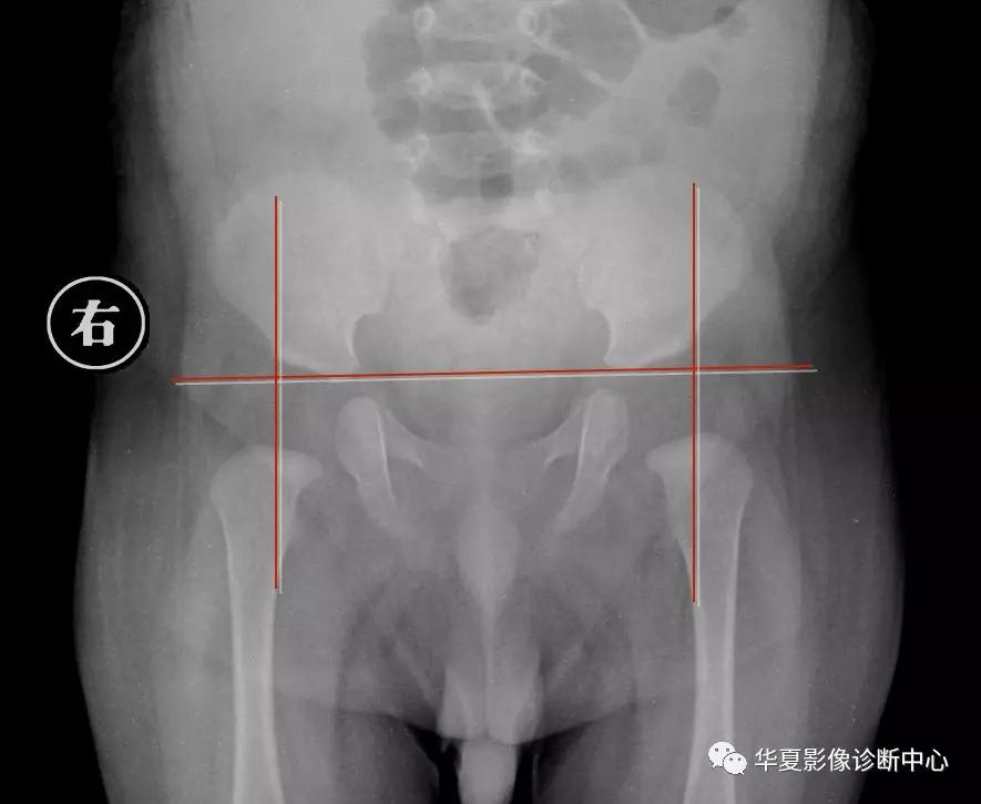 先天性髋关节脱位,先天性髋关节脱位属不属于残疾人