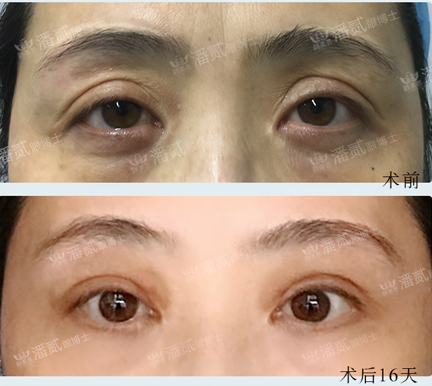 高难度修复双眼皮宽改窄恢复期,高难度双眼皮修复案例