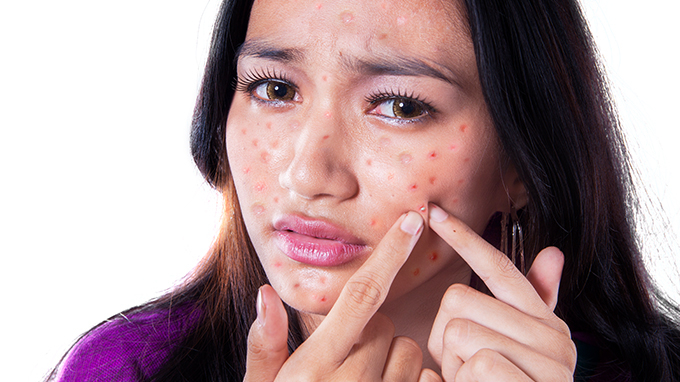怎么防止脸上长痘痘,防止脸上长痘痘最好的方法