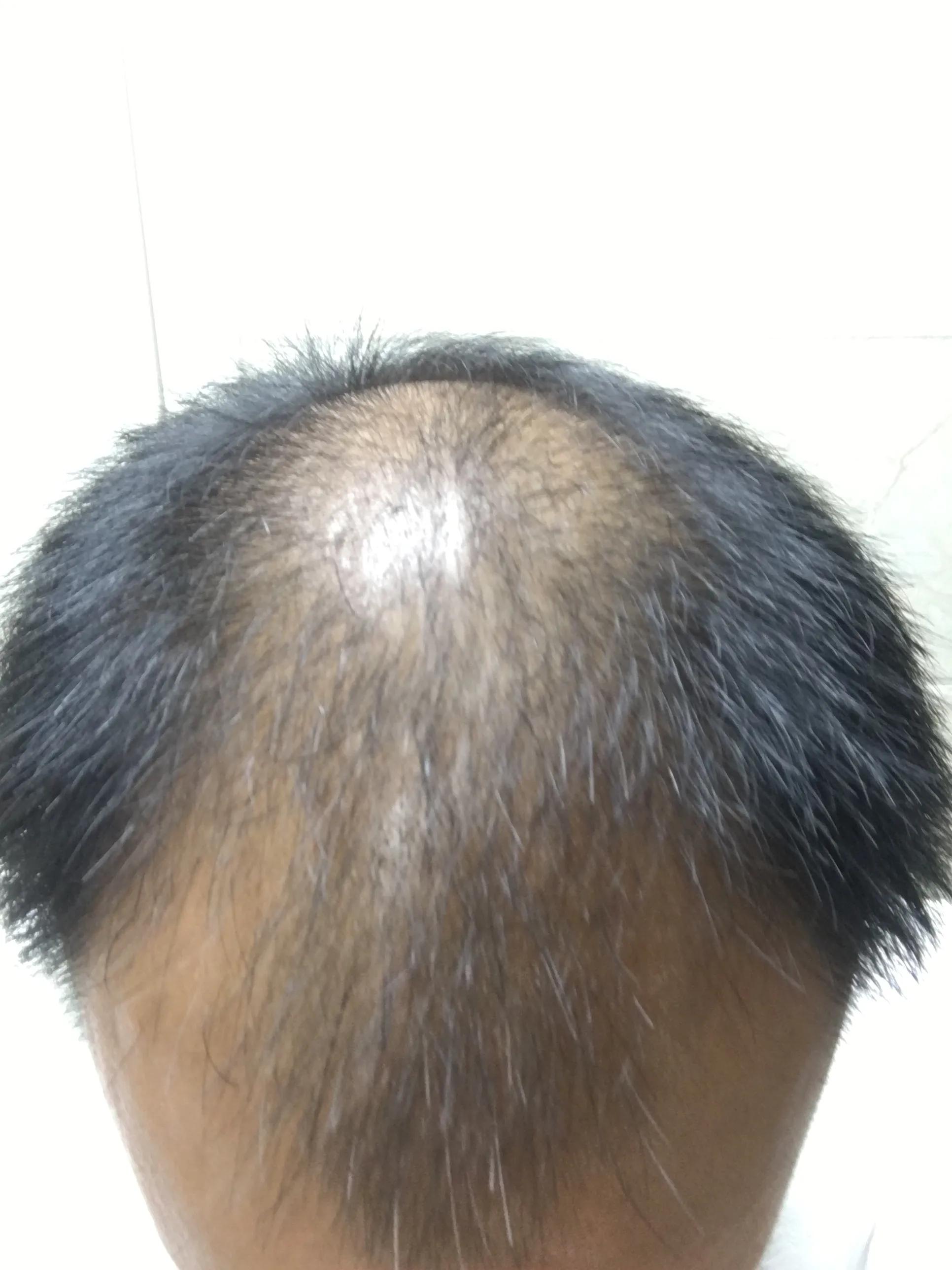 有谁治好了脂溢性脱发,脂溢性脱发用什么洗头