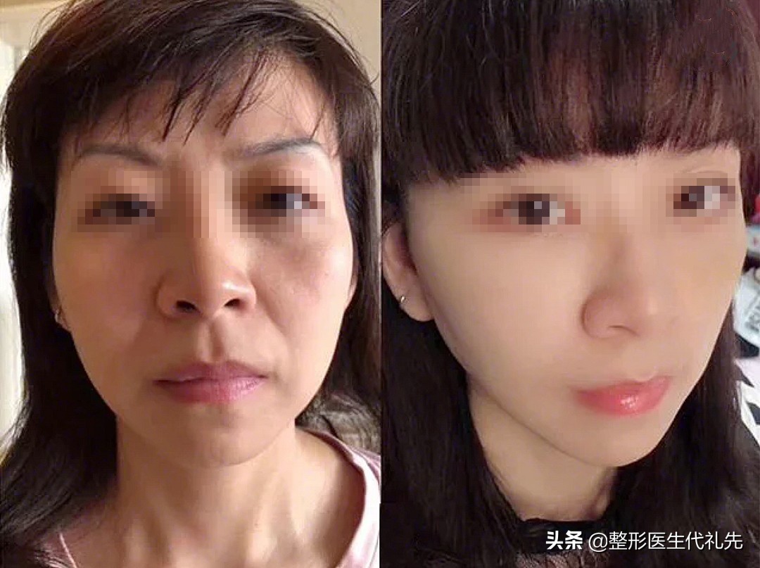 smas拉皮手术,smas大拉皮手术适合多大年龄