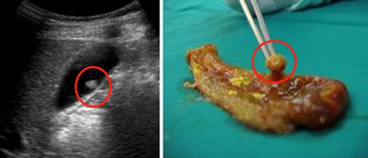 多发息肉不容易癌变,身上哪些部位长息肉会癌变