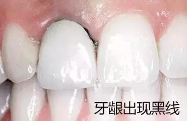 烤瓷牙做了人变丑了,烤瓷牙套里的牙烂了有什么症状