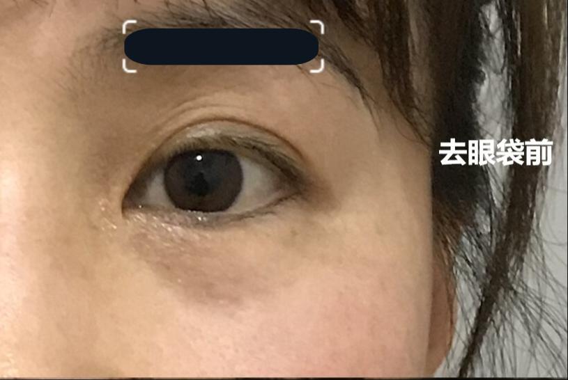 内切眼袋7天恢复全程记录,内切去眼袋恢复需要怎样做