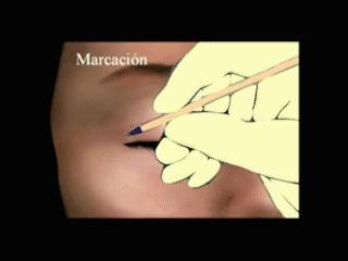 割双眼皮后怎样可以尽快完全恢复,割双眼皮的危害老了以后会怎样