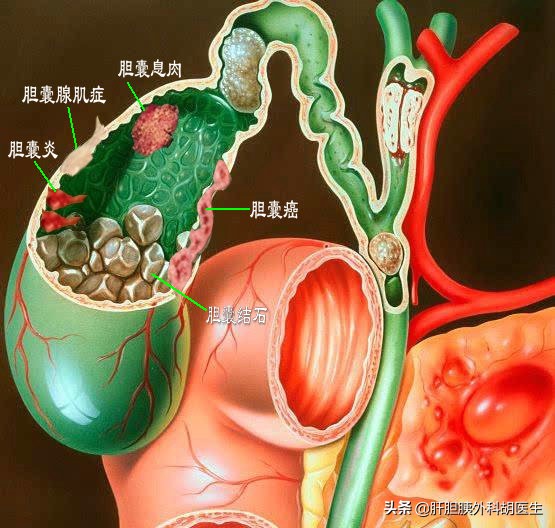 胆囊结石伴随胆囊息肉怎么办,胆囊息肉已经1.9厘米了会不会癌变