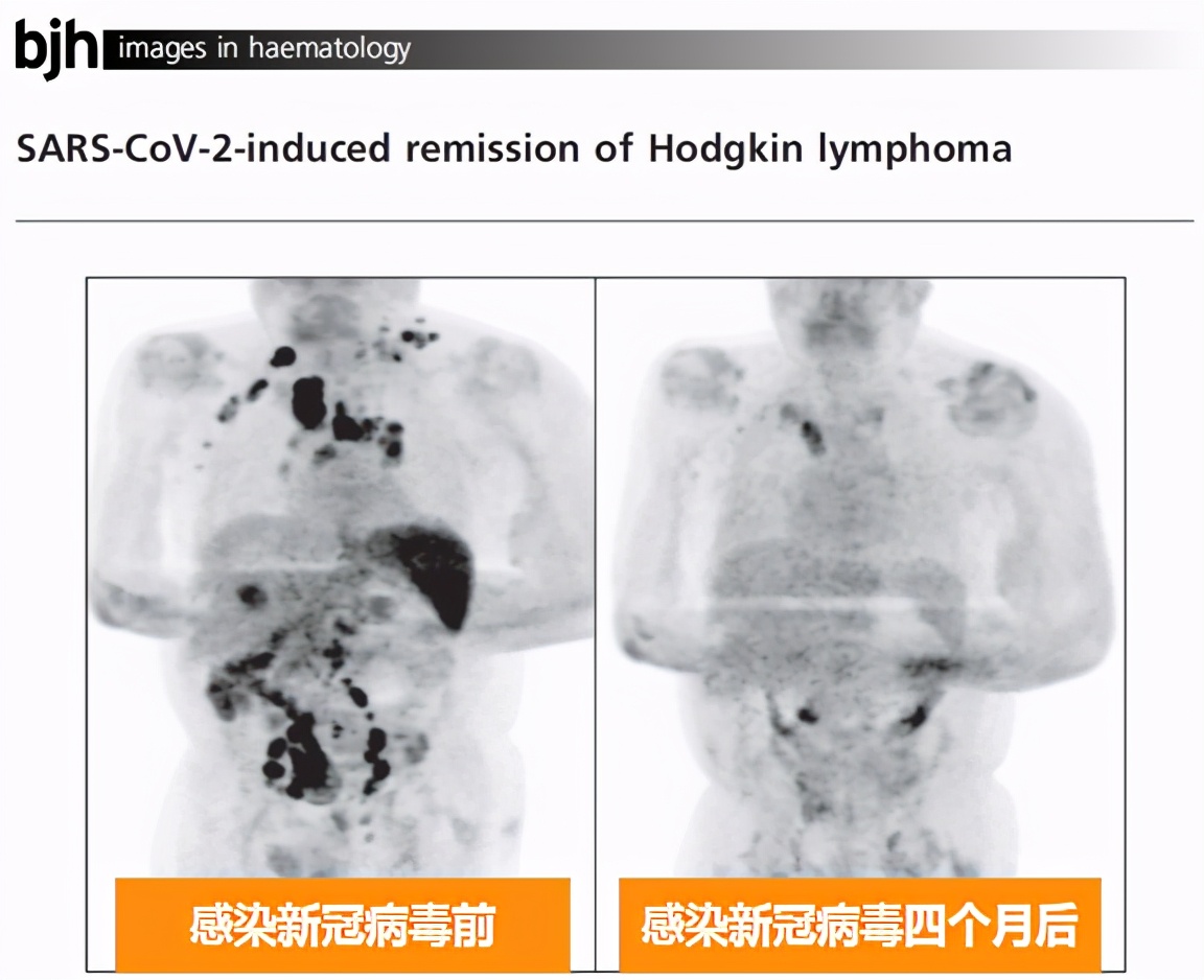 打新冠疫苗得新冠,打新冠疫苗是提高免疫力的吗
