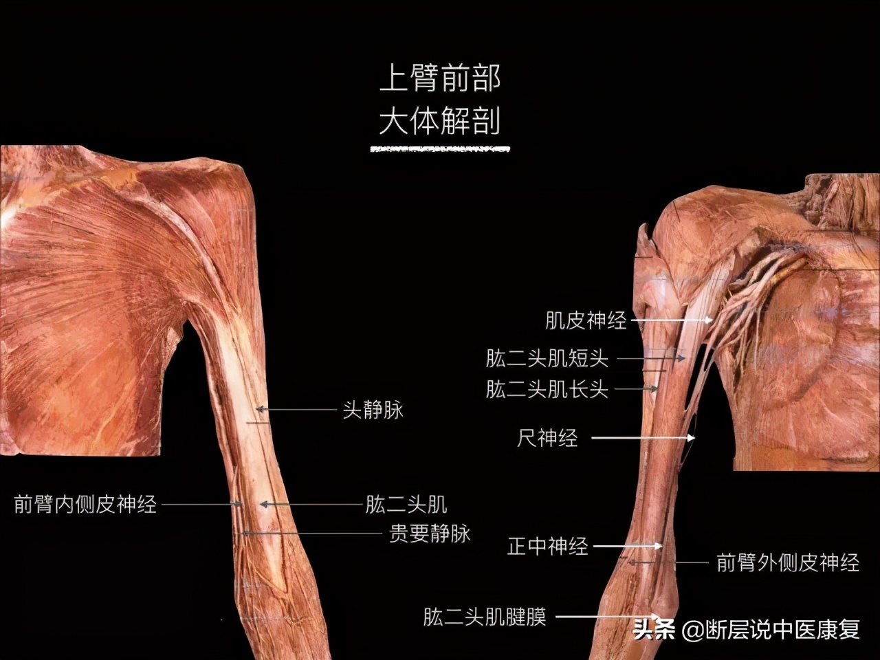 手臂人体解剖图讲解,手臂上举3d肌肉解剖讲解