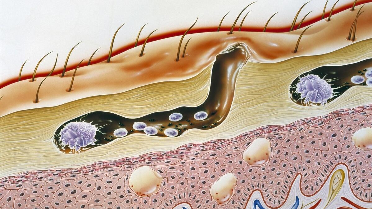 鼻子上挤出来的白色丝状物，看起来像一条虫子，是螨虫吗？