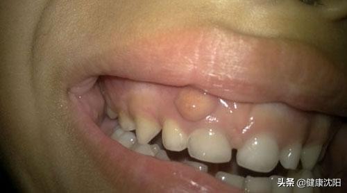 牙龈有脓包怎样引流,把牙龈里的脓水吃下去了怎么办