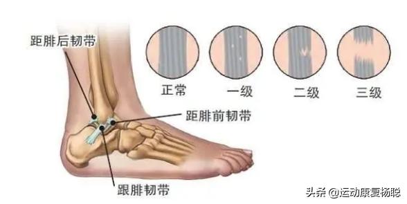 脚踝扭伤长期不好,脚踝扭伤后休息20天怎么康复