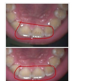 洁牙后，牙齿出现黑斑，是蛀牙了吗？再也不去洁牙了