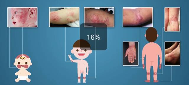 宝宝的疹子到底是什么原因？又该怎么护理？看这篇就够了