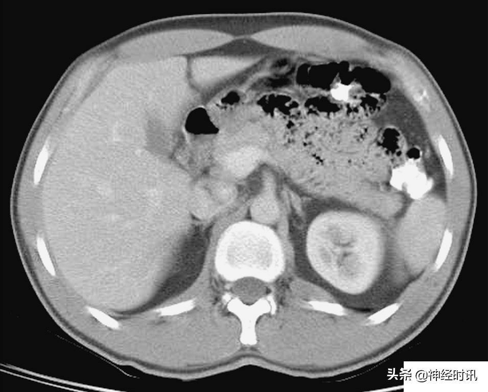 肾脏输尿管膀胱前列腺结构,肾输尿管膀胱解剖示意图