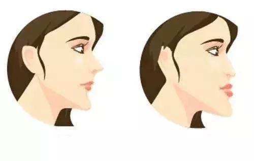 隆鼻的最佳方案,注射隆鼻的四大功效