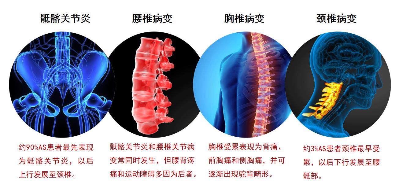 强直性脊柱炎多大几率残疾,强直性脊柱炎不治疗多久会驼背