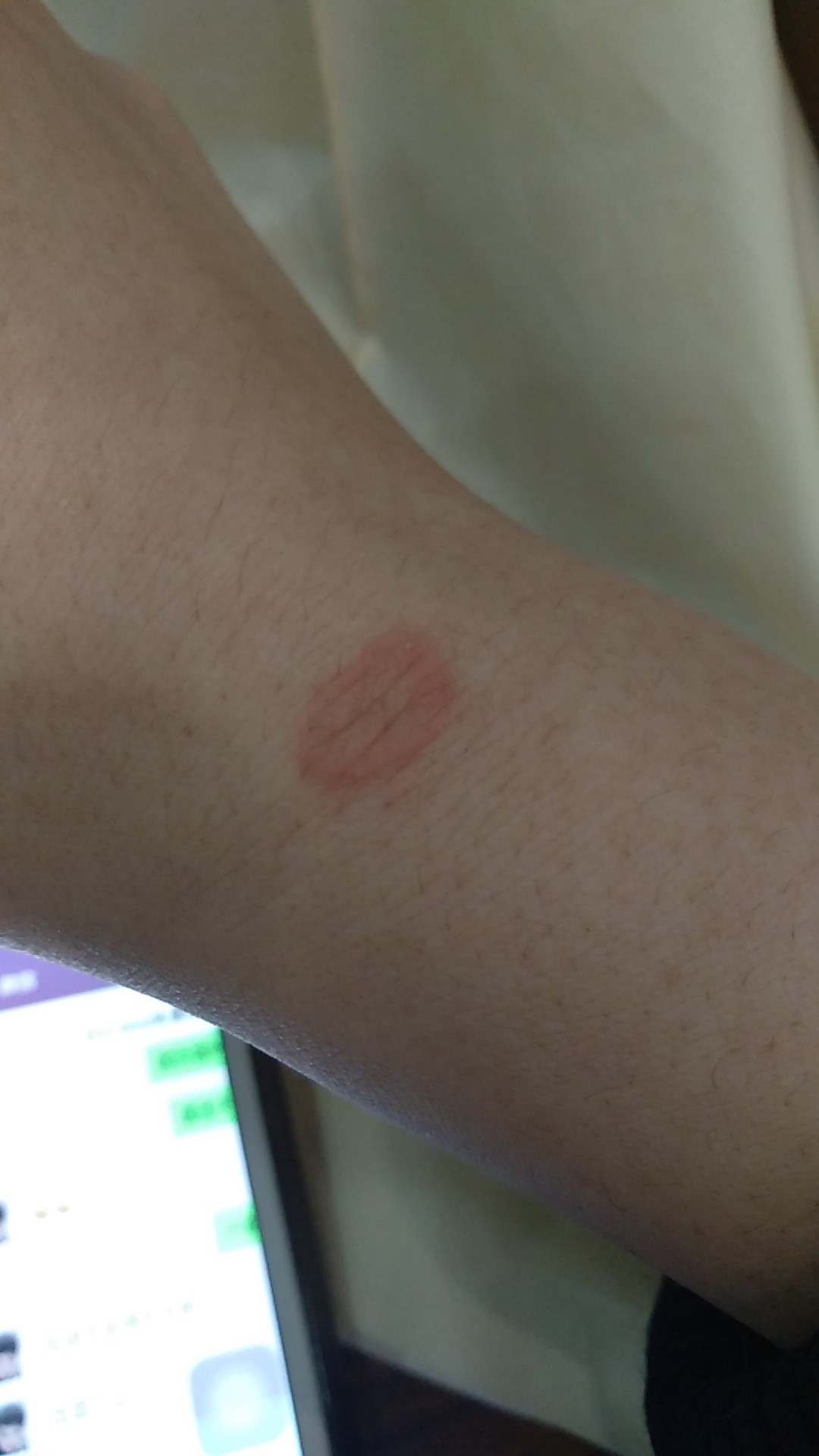 猫咪得了猫癣比较严重怎么办,猫咪得了猫癣能彻底治愈吗