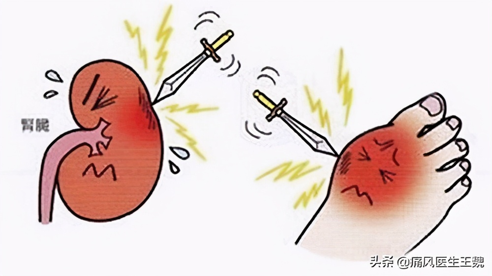 高尿酸血症肾损害的临床表现,高尿酸肾损害指南